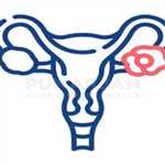 Best Ovarian Cancer Treatment Hospitals in Hyderab 